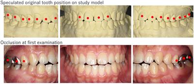 Case series of drug-induced open bite: Extrapyramidal symptoms related to psychotropic medications